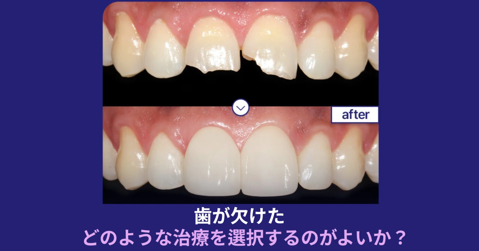 歯が欠けた、どのような治療を選択するのが良いか？メリット