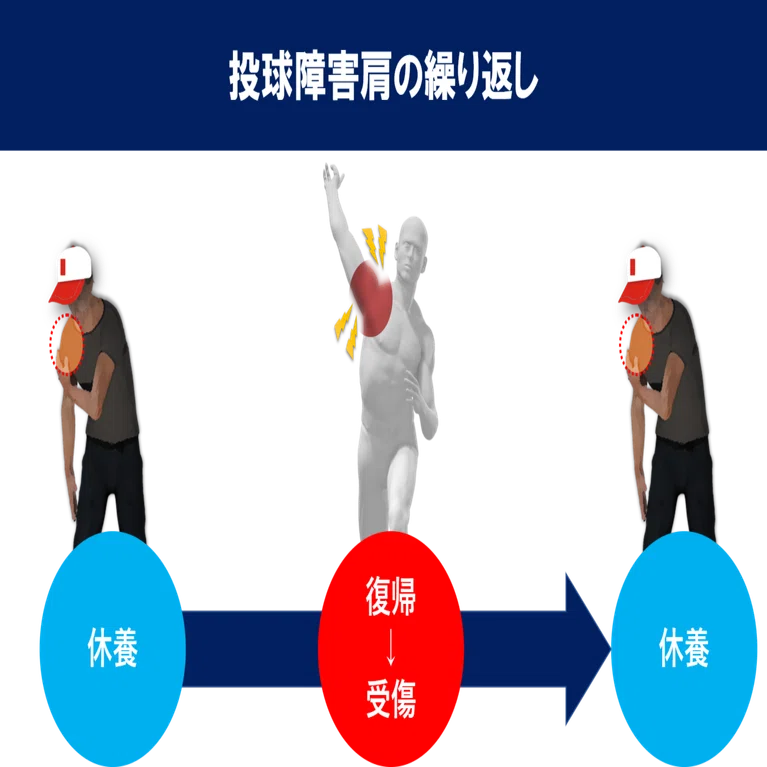 投球障害肩の病態と動作｜小林 弘幸