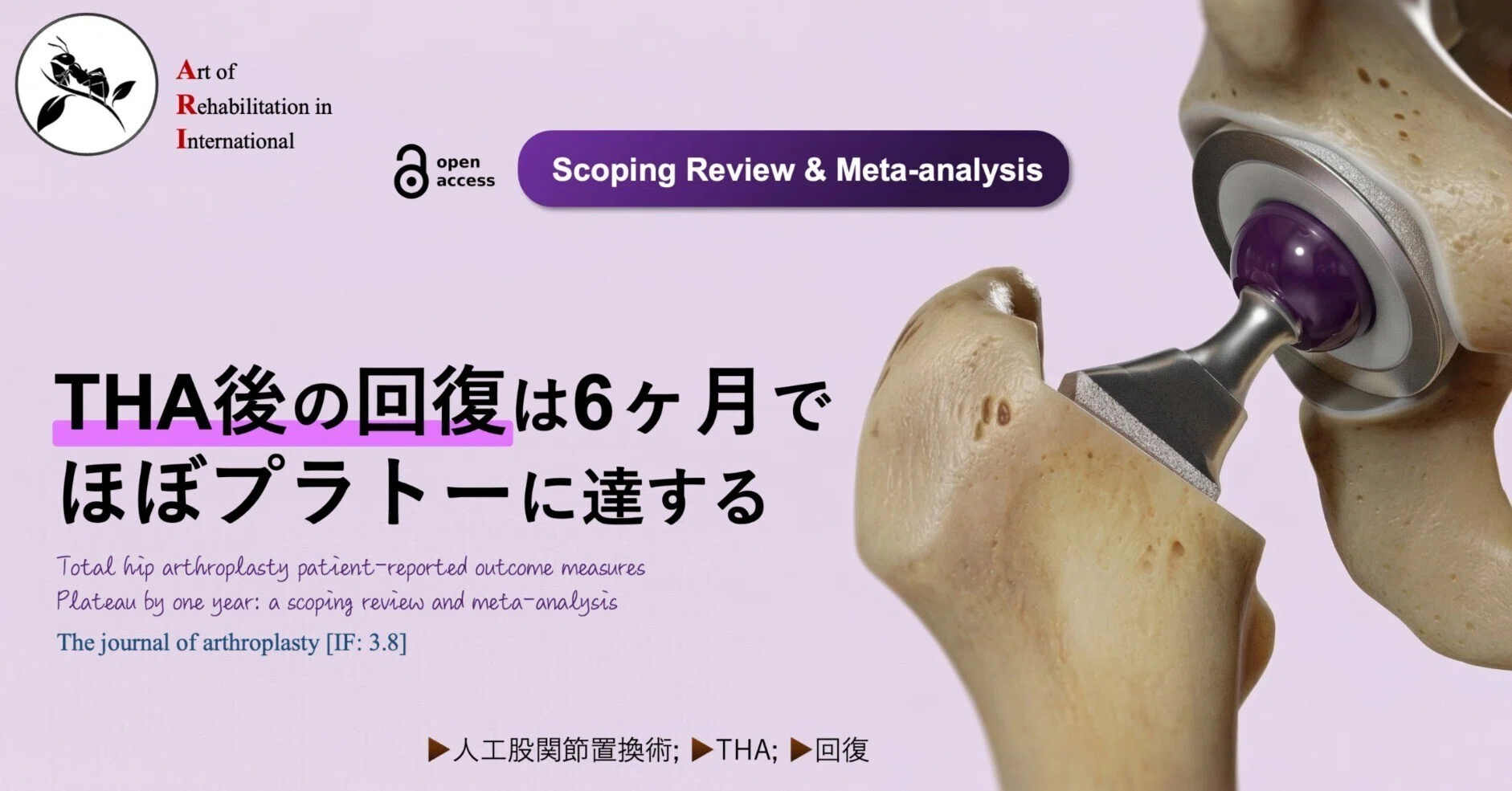 THA後の回復は6ヶ月でほぼプラトーに達する｜Super Human | 理学療法士