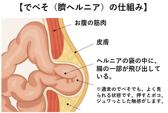 でべそ