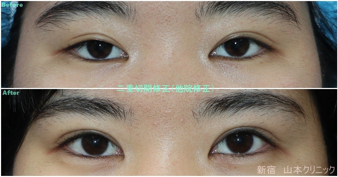 二重が眠そうなら 皮膚切除 新宿 山本クリニック Note