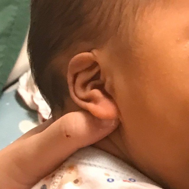 赤ちゃんの折れ耳 埋没耳矯正について 朝寝とんかつ Note