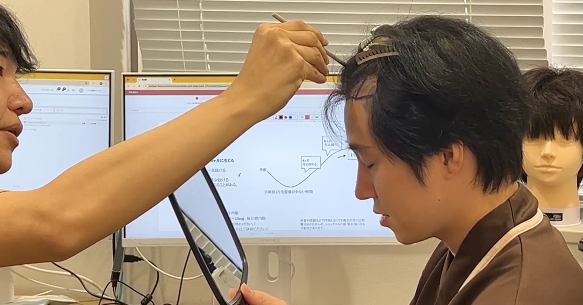 カノックスターさん（カノさん）の植毛手術 Part1｜内田直宏｜アルモ 