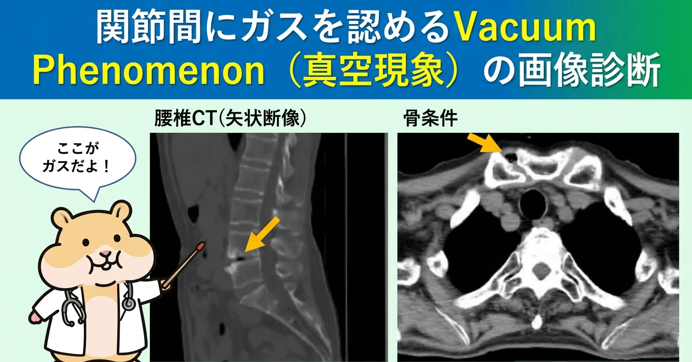 Diagnostic Imaging of the Vacuum Phenomenon: Gas in the Joints