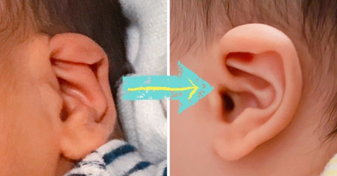 赤ちゃんの折れ耳 埋没耳矯正について 朝寝とんかつ Note