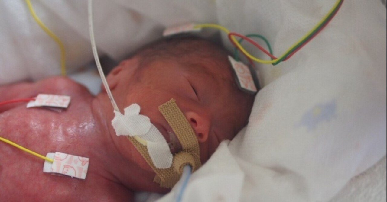 超低出生体重児 Nicu奮闘記 コウノドリ出演 日齢 3 修正26週2日 山場の72時間を無事突破 成川潤 Jun Narikawa Note