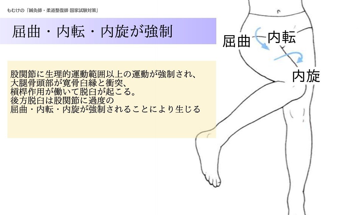 柔理 ゴロで覚える股関節後方脱臼 森元塾 国家試験対策 Note 柔理 ゴロで覚える股関節後方脱臼 森元塾 国家試験対策 Note