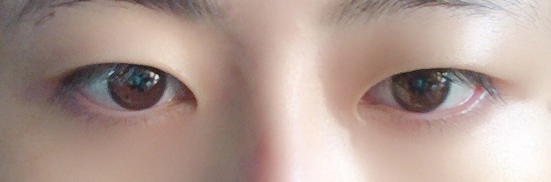 新しい顔 眼瞼下垂手術レポ トヨシマ Note 新しい顔 眼瞼下垂手術レポ トヨシマ Note