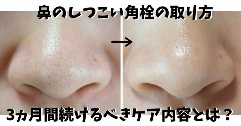 鼻の角栓が取れない しつこい角栓を取って毛穴を閉じる3ステップとは