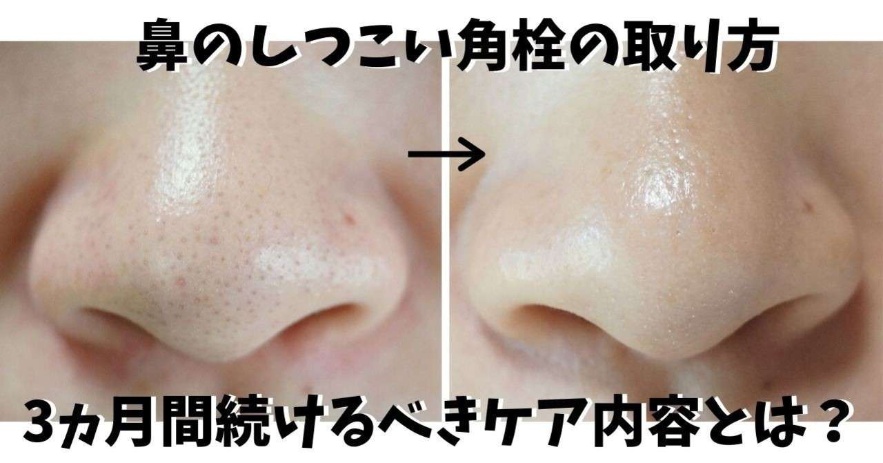 鼻の角栓が取れない しつこい角栓を取って毛穴を閉じる3ステップとは