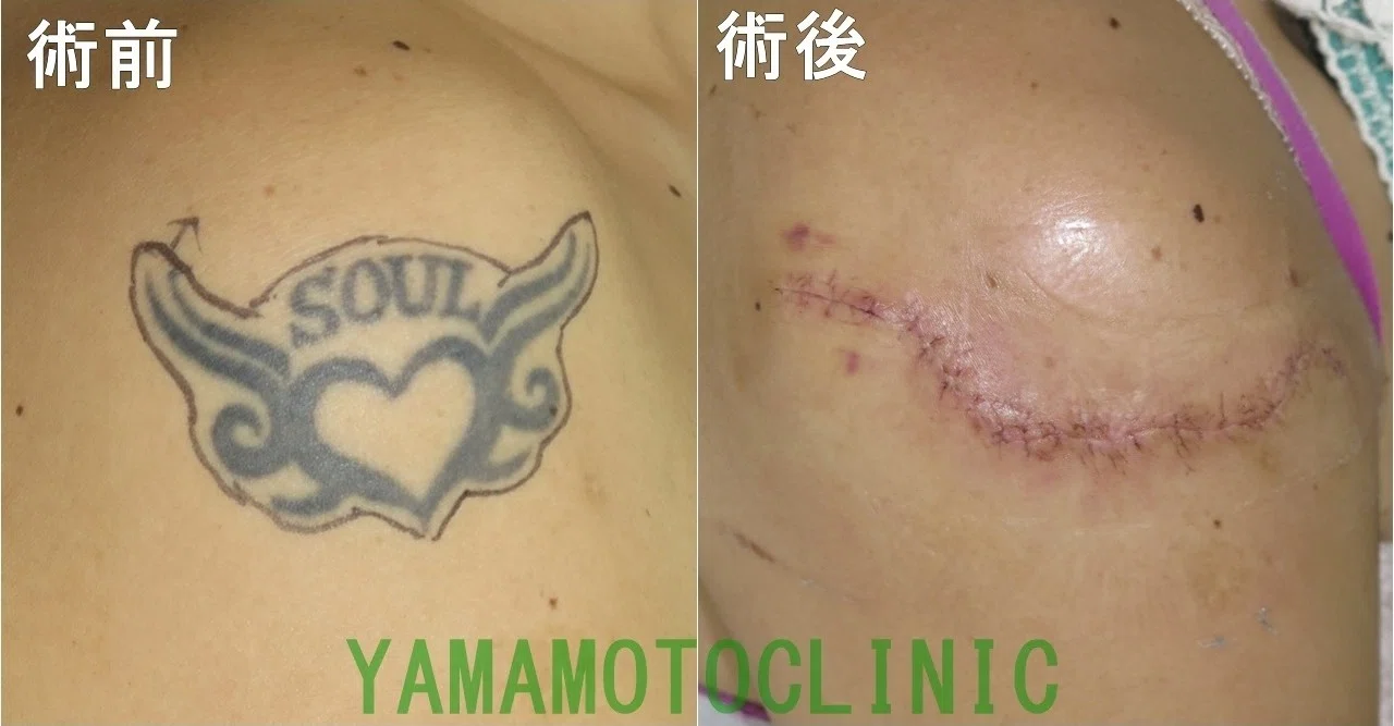 刺青 タトゥー除去もできます 新宿 山本クリニック Note