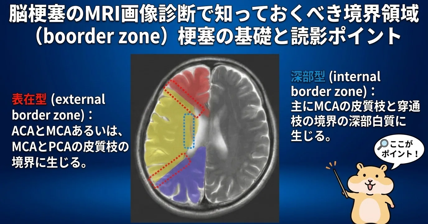 脳 梗塞 mri