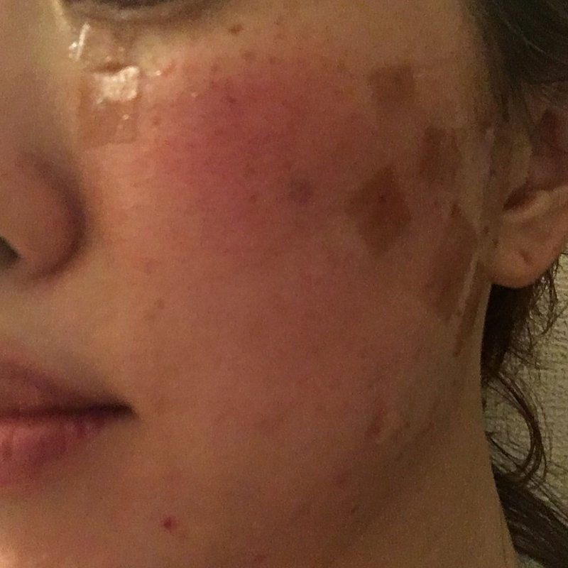 ホクロ除去 Iplフォトフェイシャル3日目と薬 悦 Note