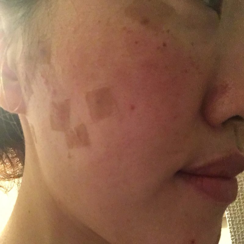 ホクロ除去 Iplフォトフェイシャル3日目と薬 悦 Note