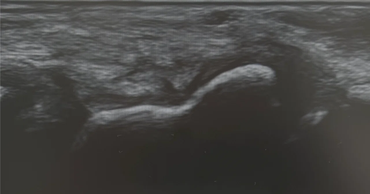 Navicular Cortex Mri Differential Diagnosis of Scaphoid Fracture Using Ultrasound Imaging in ...