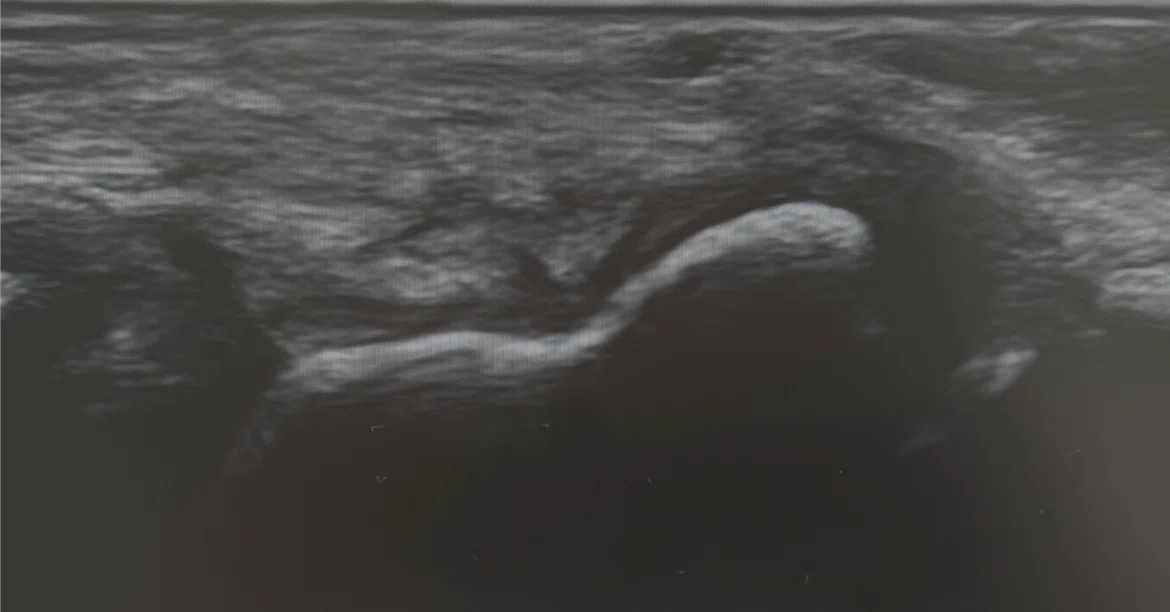 Navicular Cortex Mri Differential Diagnosis of Scaphoid Fracture Using Ultrasound Imaging in ...