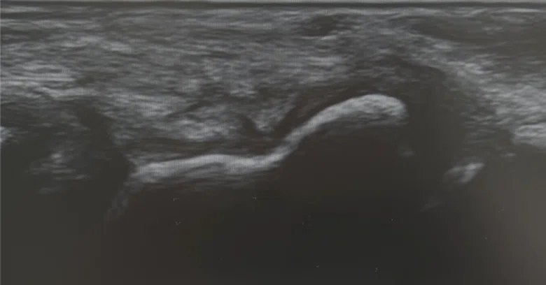 Navicular Cortex Mri Differential Diagnosis of Scaphoid Fracture Using Ultrasound Imaging in ...