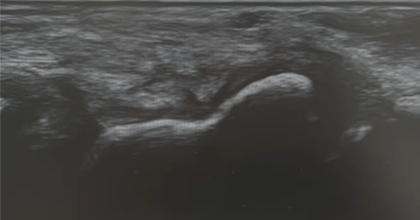 Navicular Cortex Mri Differential Diagnosis of Scaphoid Fracture Using Ultrasound Imaging in ...