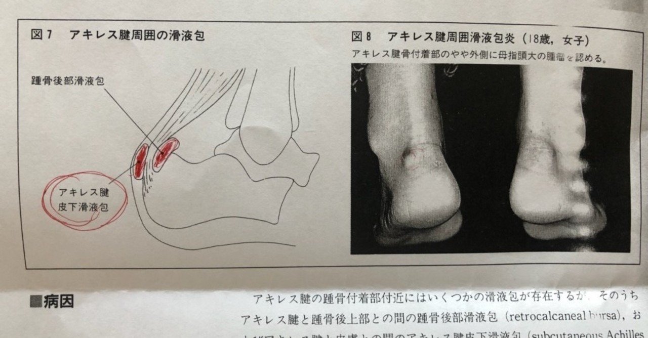 Note59日目 アキレス腱滑液包炎 ふーちゃん Note