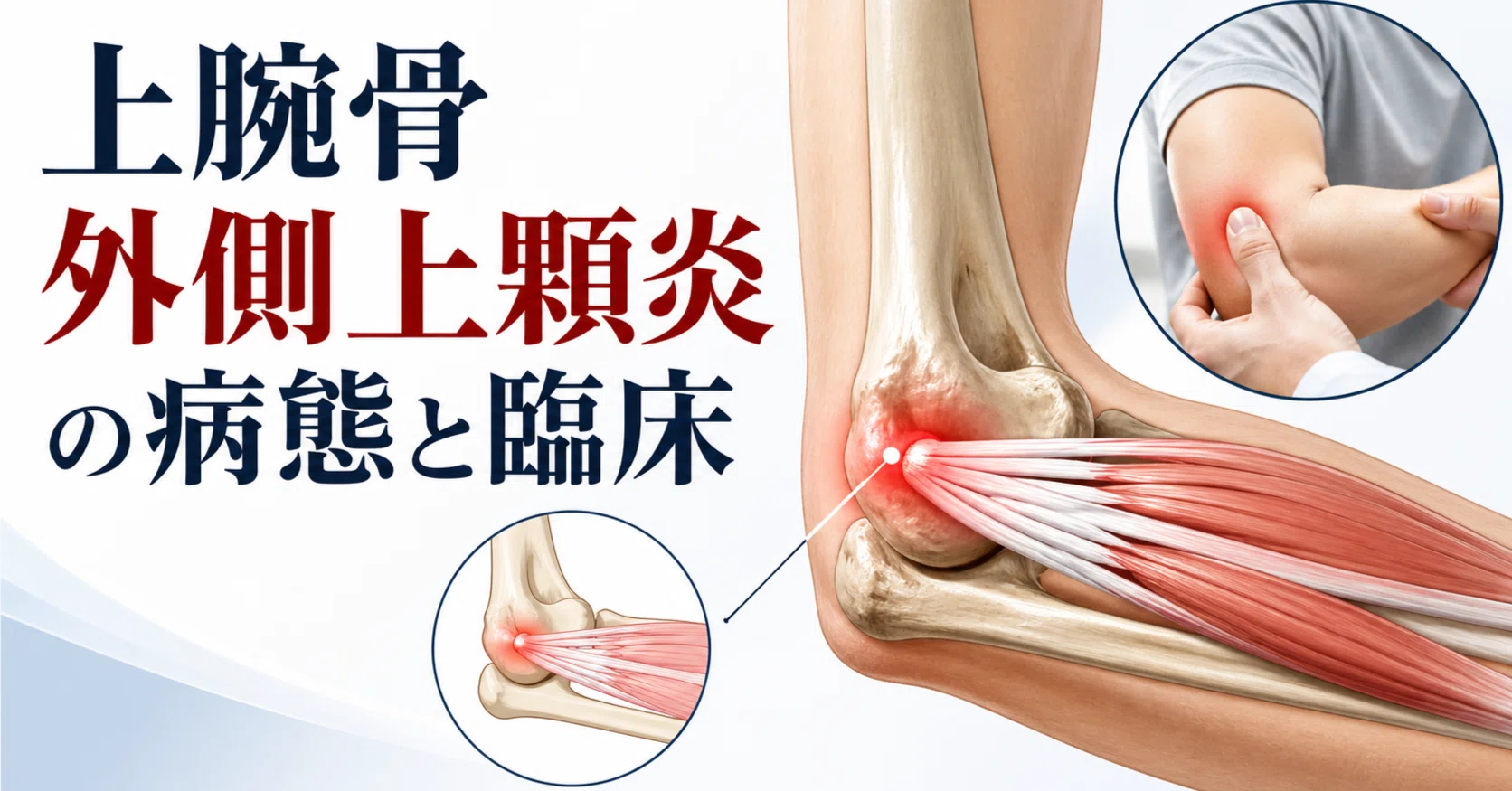 外側 上 顆 炎