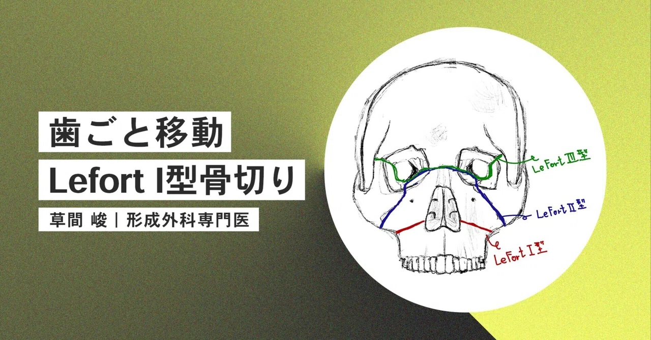 歯が生えている上顎を丸ごと切り離して移動する「LeFort I型骨切り」とは？｜草間 峻 | 形成外科専門医