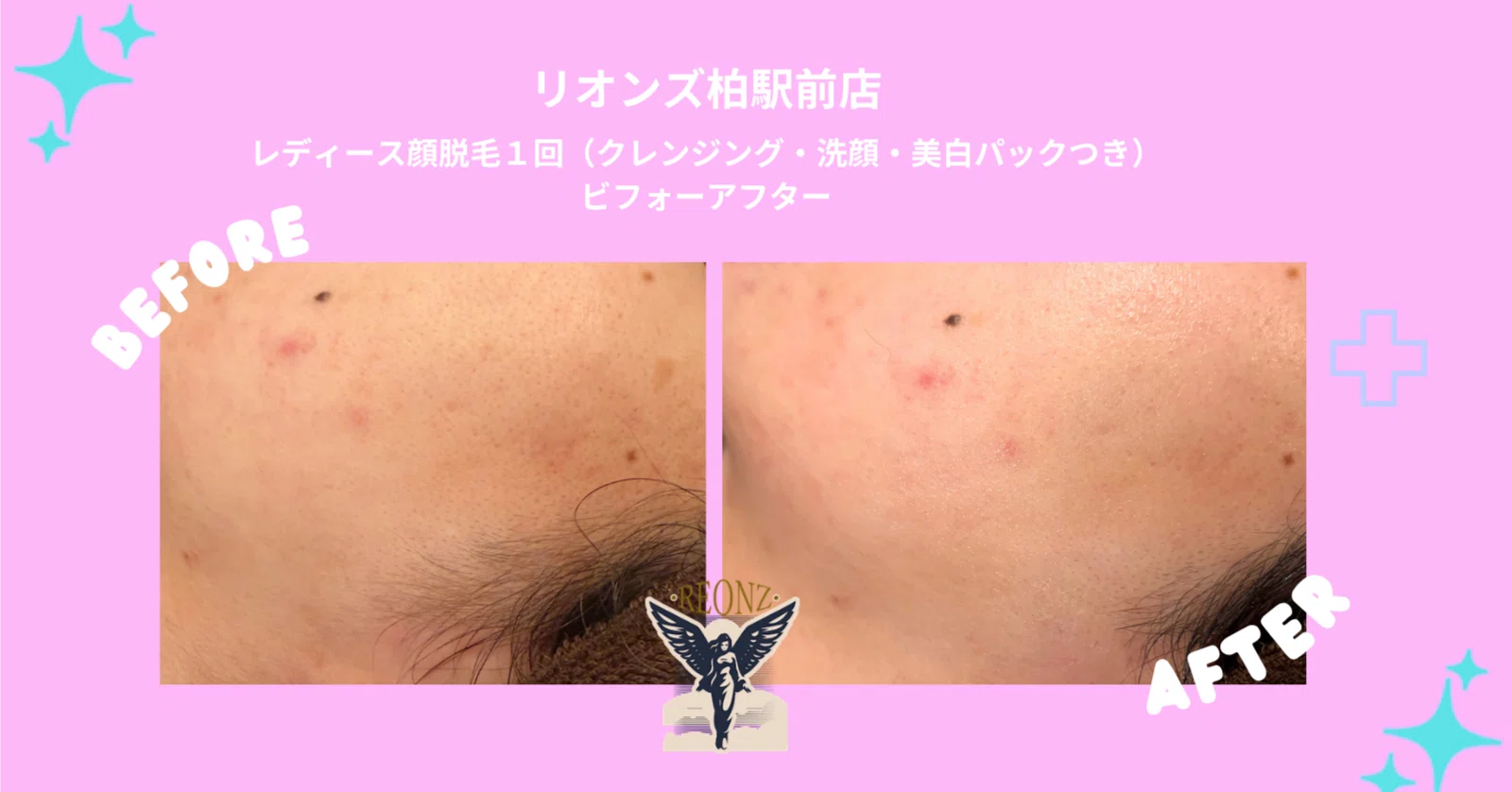顔 脱毛 ビフォー アフター