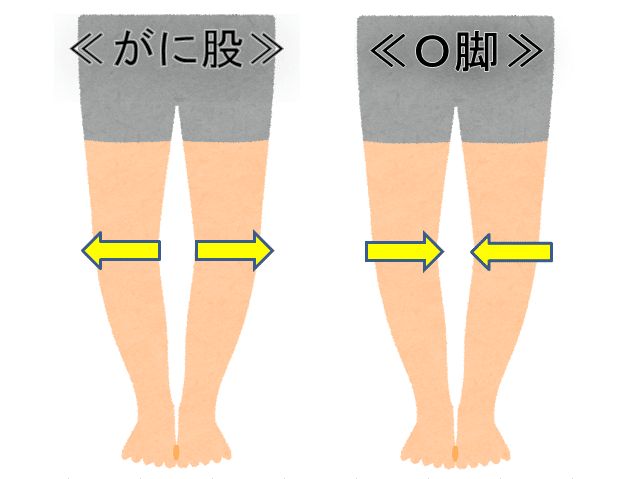 がに股とｏ脚の違い 西宮 ながた整体院 Note