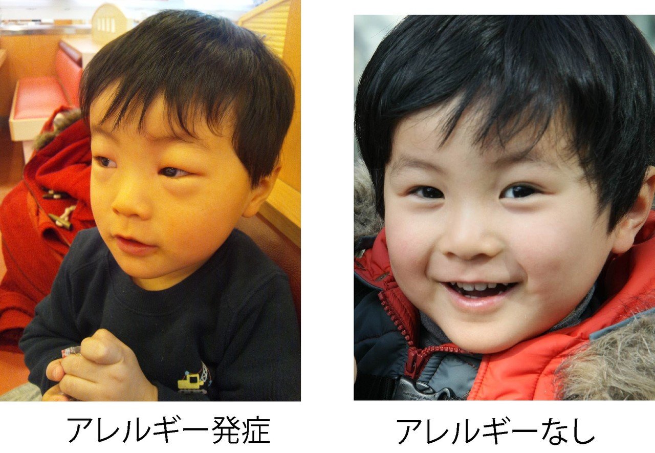 お友達のアレルギーのお話を受けて わが家の息子の歴史 保育園の給食でアナフィラキシー発動 呼吸困難 嘔吐 腫れ 湿疹 半日後回復 Chamland Note お友達のアレルギーのお話を受けて わが家の息子の歴史 保育園の給食でアナフィラキシー発動 呼吸困難 嘔吐 腫れ 湿疹 半日後回復 Chamland Note