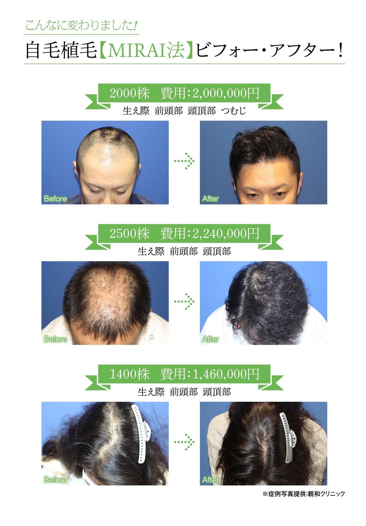 使い勝手の良い 増毛 円脱 薄毛シート状植毛 白髪１０ Www iwearparts Com