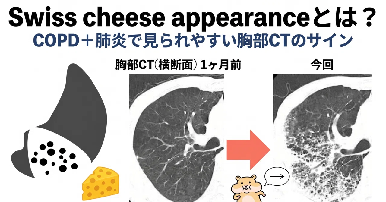 Swiss cheese appearanceとは？COPD＋肺炎で見られやすい胸部CTの 