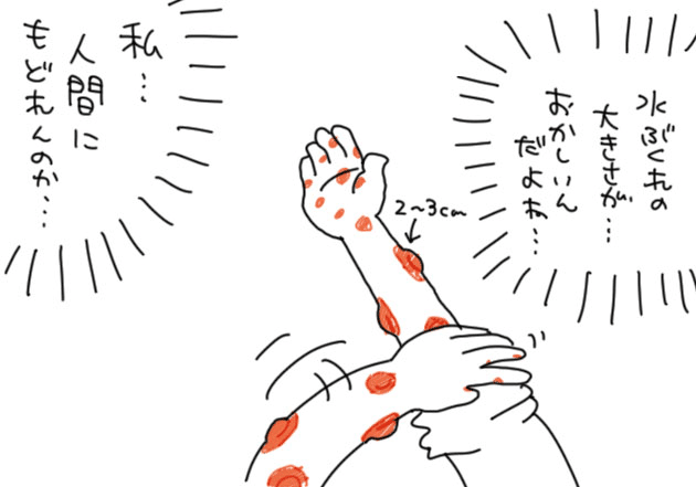 大人の水疱瘡 ６日目 アベナオミ Note
