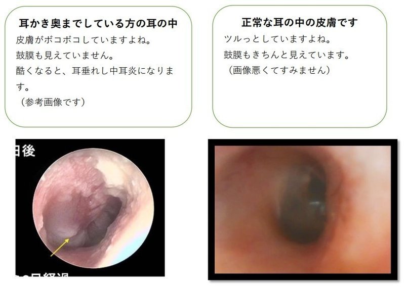 耳かき どこまで奥に入れてる ねむりサロン33mimi Note