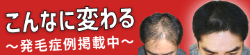 20191009薄毛治療ならスーパースカルプ発毛センター