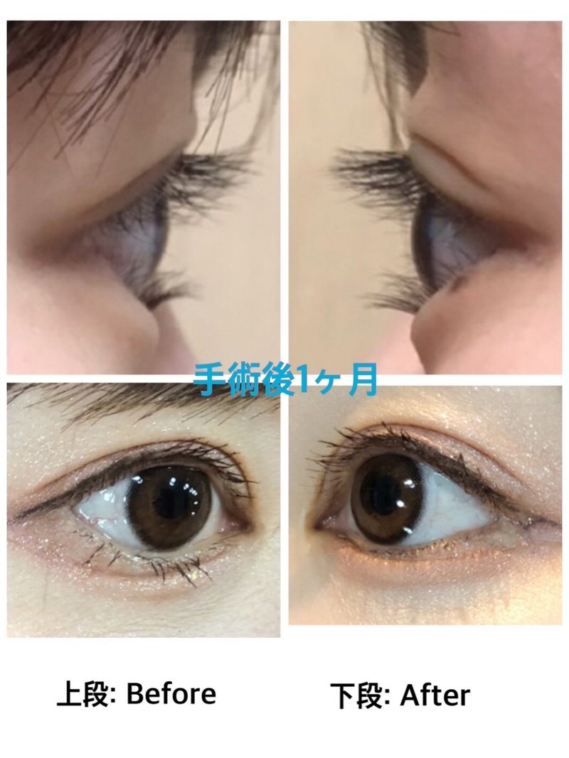 画像をダウンロード 逆さ まつ毛 手術 画像 Saikonomuryofuse
