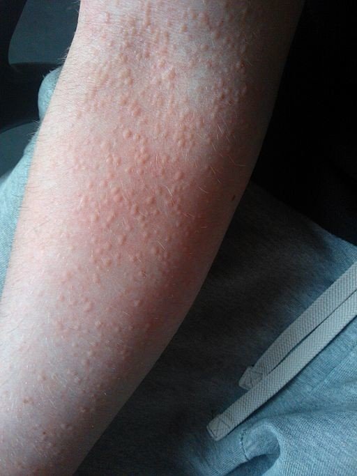 アレルギー 汗 アトピー性皮膚炎患者における汗アレルギーの原因物質を同定