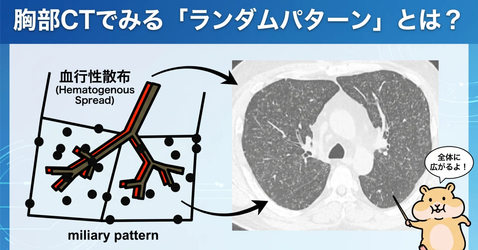 胸部CTでみる「ランダムパターン」とは？｜とっとこ画像診断太郎
