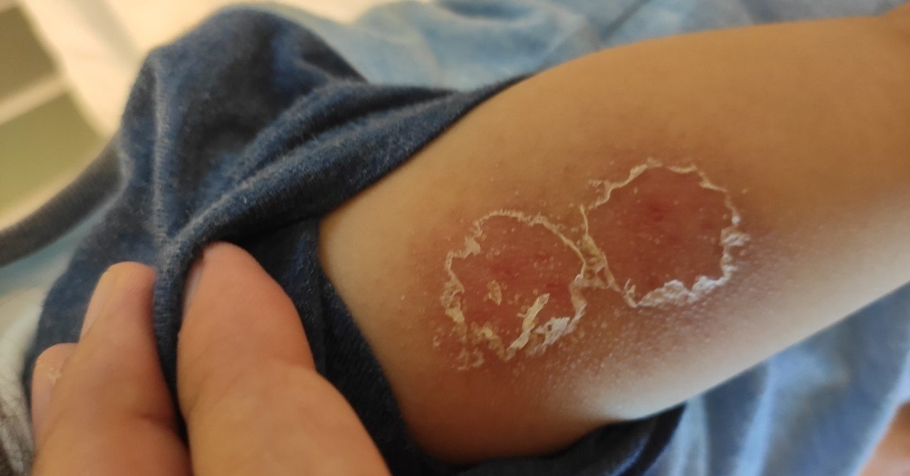 息子のbcg痕が腫れてたと思ったら入院してた話 ホンマハヤテ おかしなこうじや 丹波のちょっと不思議な麹屋さん Note