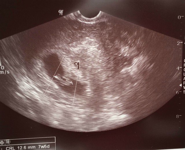 我が家の一人目妊娠レポ１ 妊娠初期 ヒナ Note