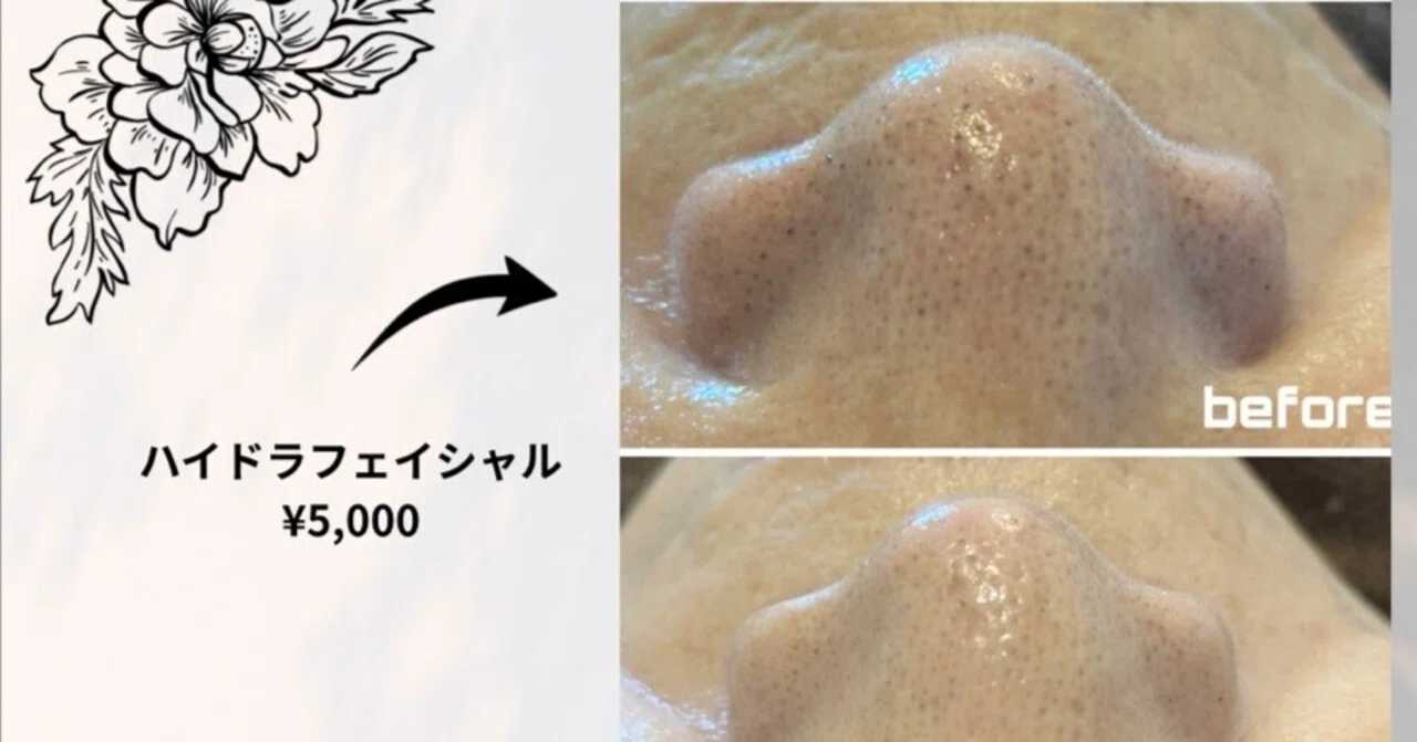 名護市で毛穴洗浄】いちご鼻・黒ずみ卒業！ハイドラフェイシャルが「肌
