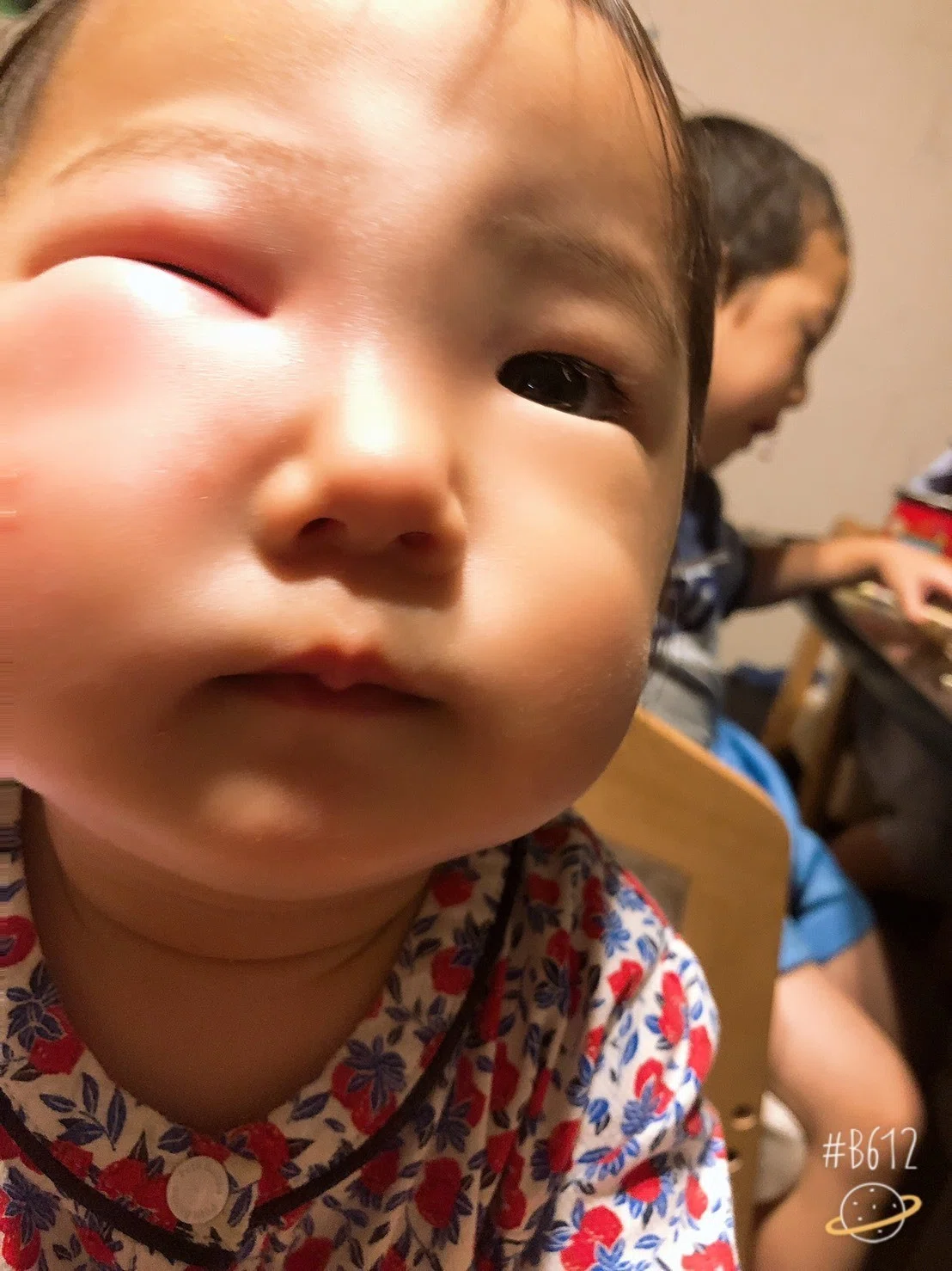 乳幼児 虫刺されと免疫力 対応策 Sachi Lotus Note 乳幼児 虫刺されと免疫力 対応策 Sachi Lotus Note