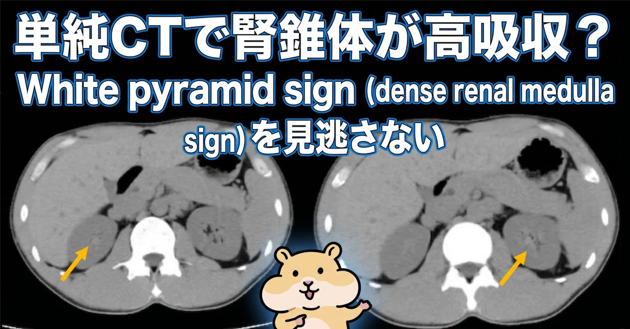 Pymarid Sign High-density renal pyramids on non-contrast CT? Don't miss the White ...
