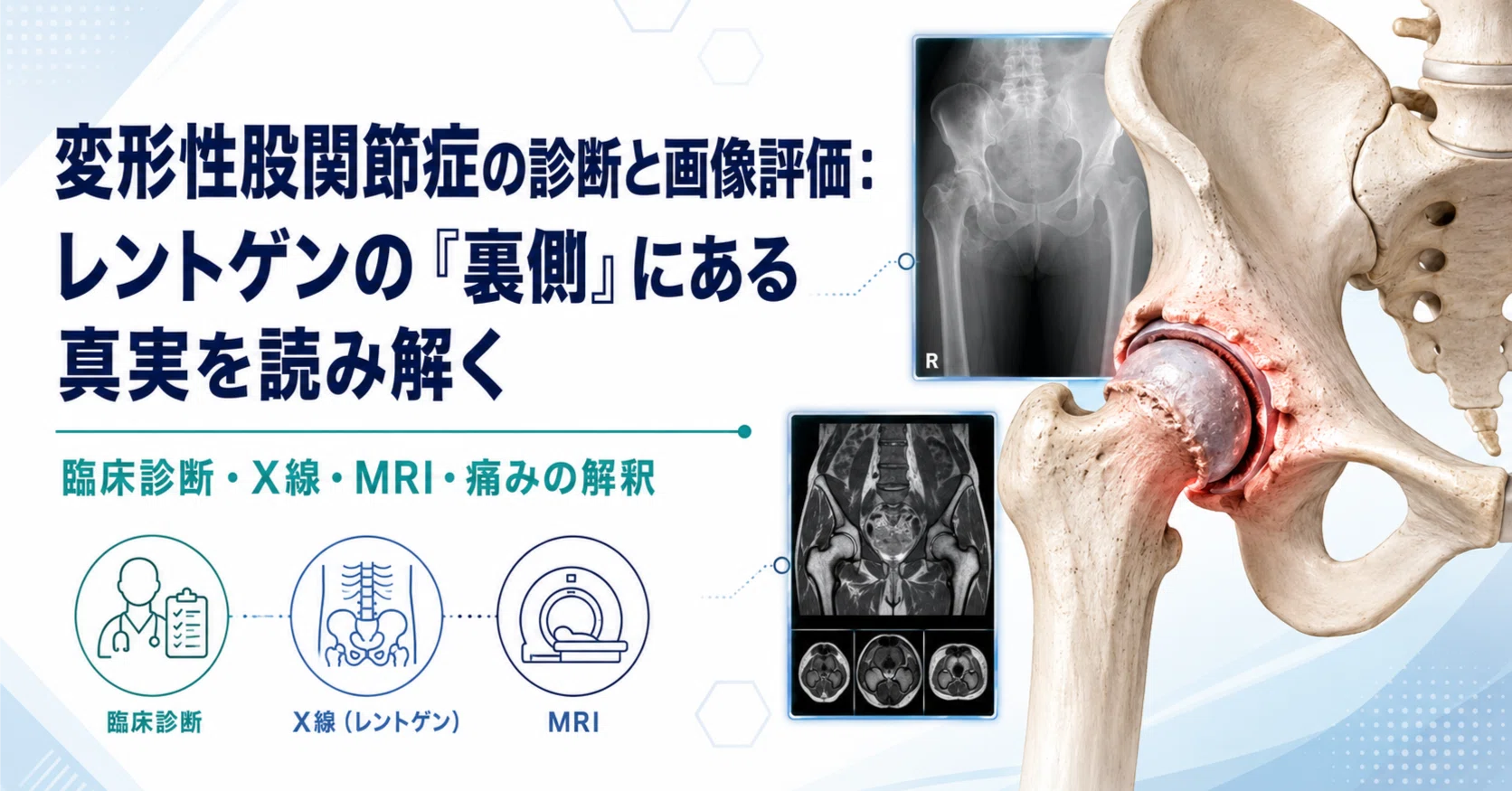 変形性股関節症の診断と画像評価：レントゲンの「裏側」にある真実を