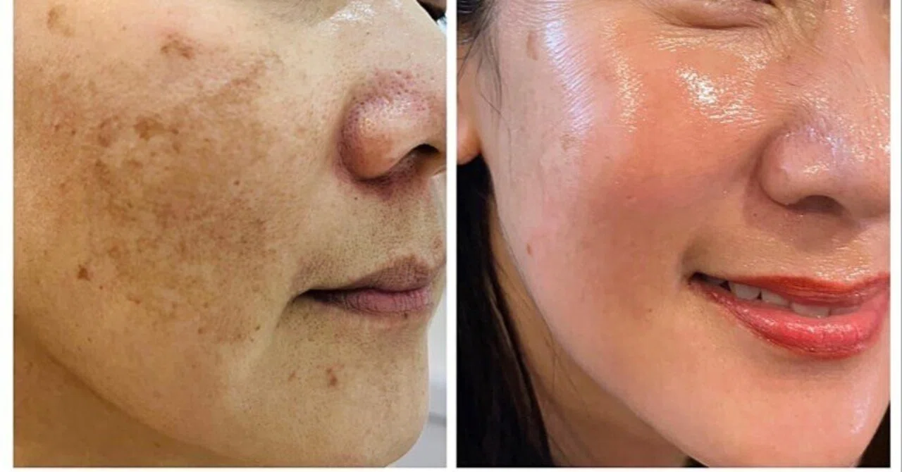 インセルダム奈良│INCELLDERM│肌のごわつきケア｜SONA_CLINICALSALON