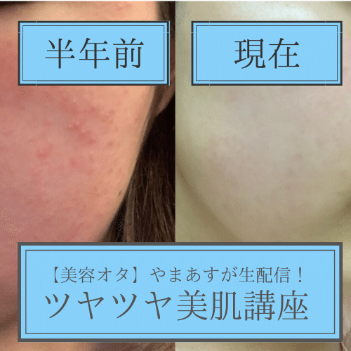 ニキビには食べ物より魂の開放の方が即効性がある話 美容オタ やまあすが教える 学校では教えてくれない 美容 マインド Note