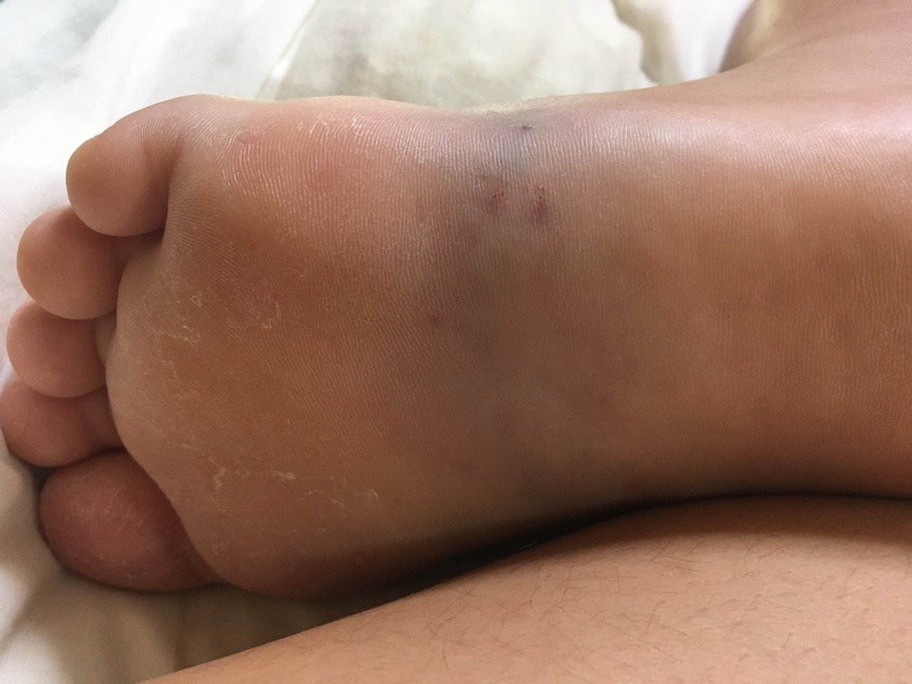 小学生がオニダルマオコゼに刺された 救急搬送までの一部始終 林 将之 Masayuki Hayashi Note 小学生がオニダルマオコゼに刺された 救急搬送までの一部始終 林 将之 Masayuki Hayashi Note