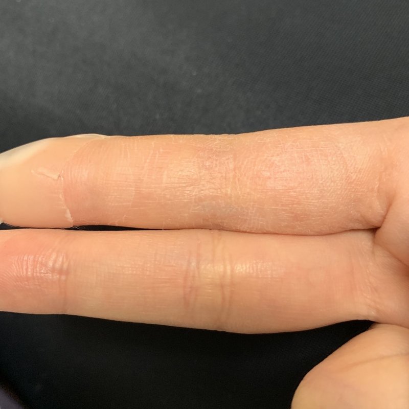 カッターで深く指を切った怪我にキズパワーパッドで湿潤療法した話 46番 Note