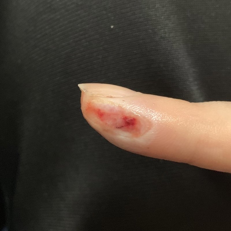 カッターで深く指を切った怪我にキズパワーパッドで湿潤療法した話 46番 Note
