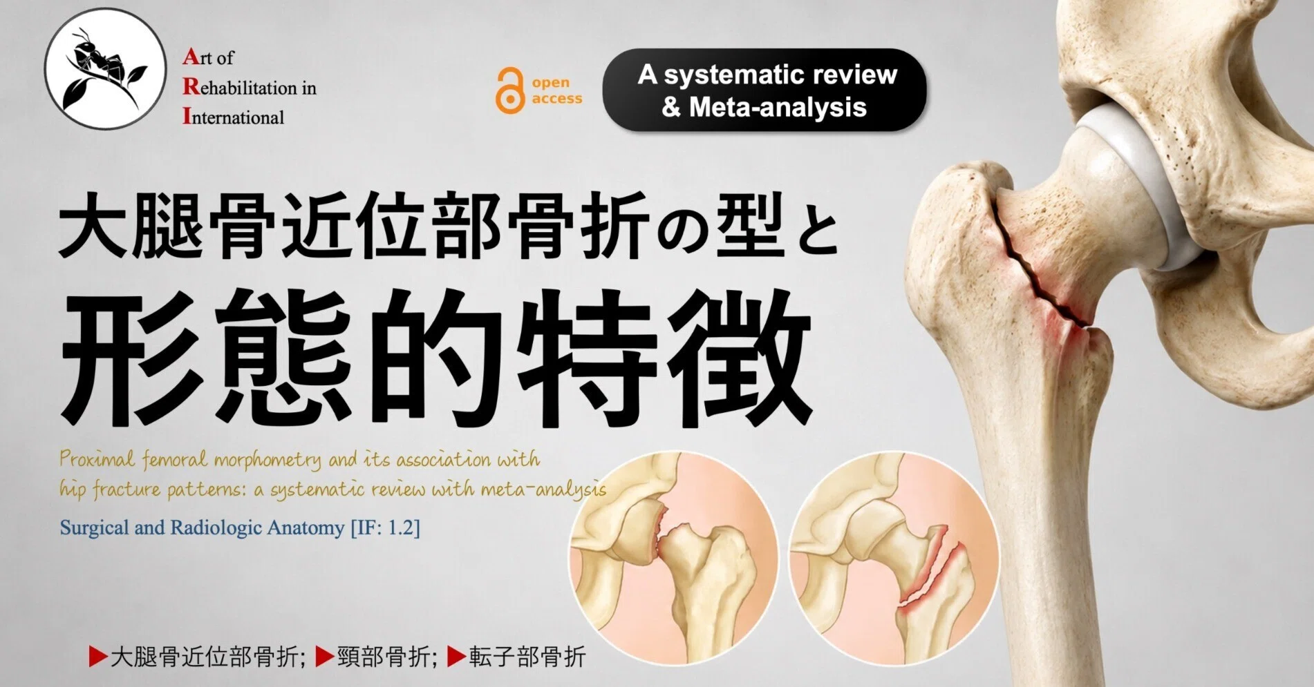 大腿骨近位部骨折の型と形態的特徴｜Super Human | 理学療法士／保健学