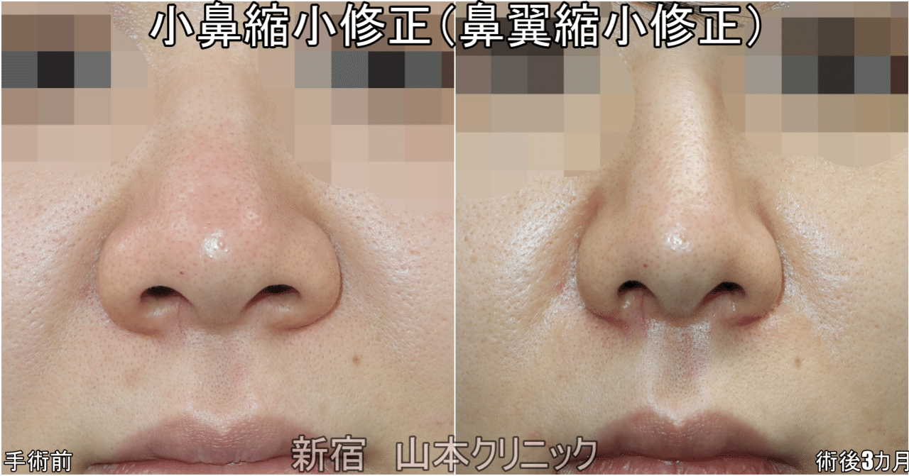 小鼻縮小のデザインは こう書く 新宿 山本クリニック Note