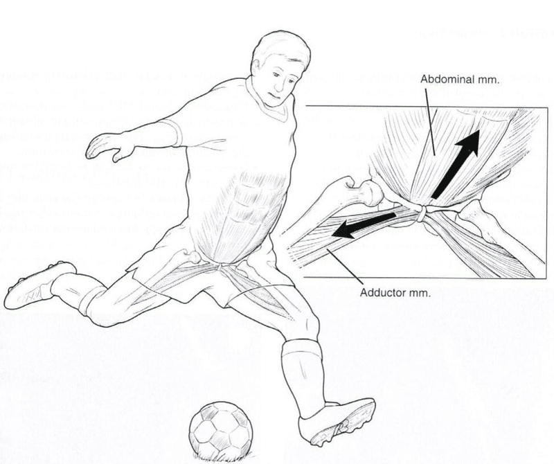 グロインペイン症候群にはコペンハーゲンがオススメ 股関節の付け根の痛みの解説 ガクトレ Note